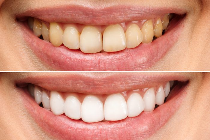 Stained Teeth Concerns - Improve Habits Before Whitening Products